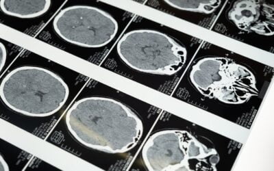 Pérdida de neuronas afecta al cerebro