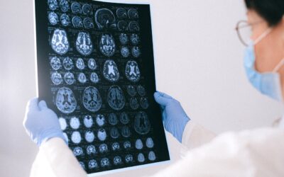 Cuerpos de Lewy y deterioro cognitivo
